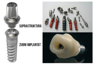 dentalni_imp
